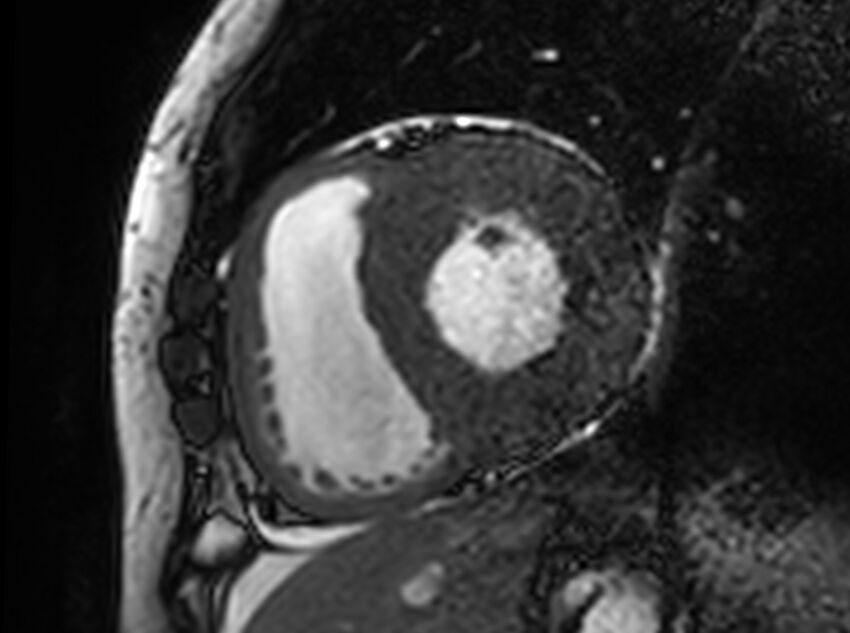Cardiac amyloidosis (Radiopaedia 61600-69579 Short axis bSSFP 217).jpg