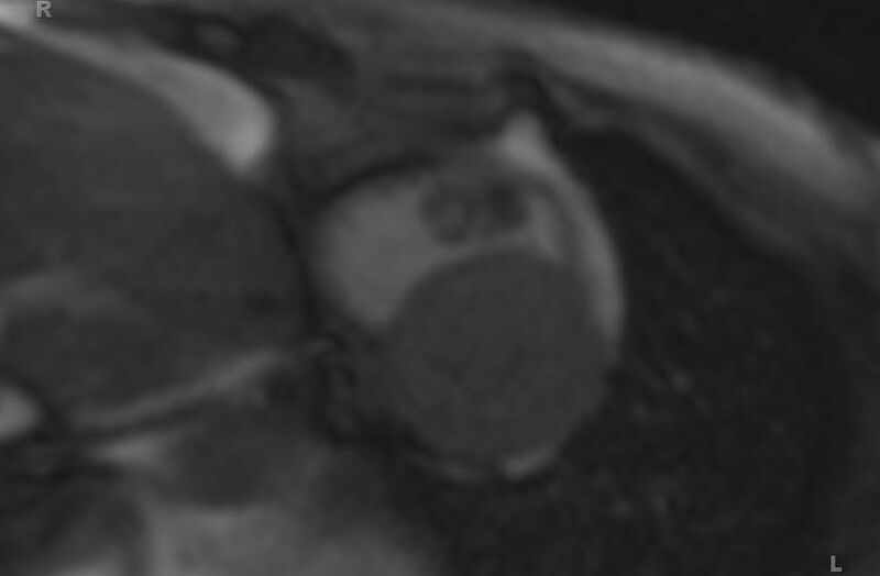 File:Cardiac hemangioma (Radiopaedia 31709-32631 Short axis 75).jpg