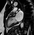 Cardiac sarcoidosis (Radiopaedia 74548-85535 2ch Cine SSFP 13).jpg