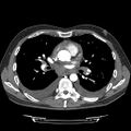 Cardiac tamponade (Radiopaedia 78607-91368 Axial C+ CTPA 43).jpg