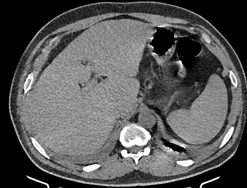 File:Cardiogenic pulmonary edema (Radiopaedia 68180-77678 Axial non-contrast 58).jpg