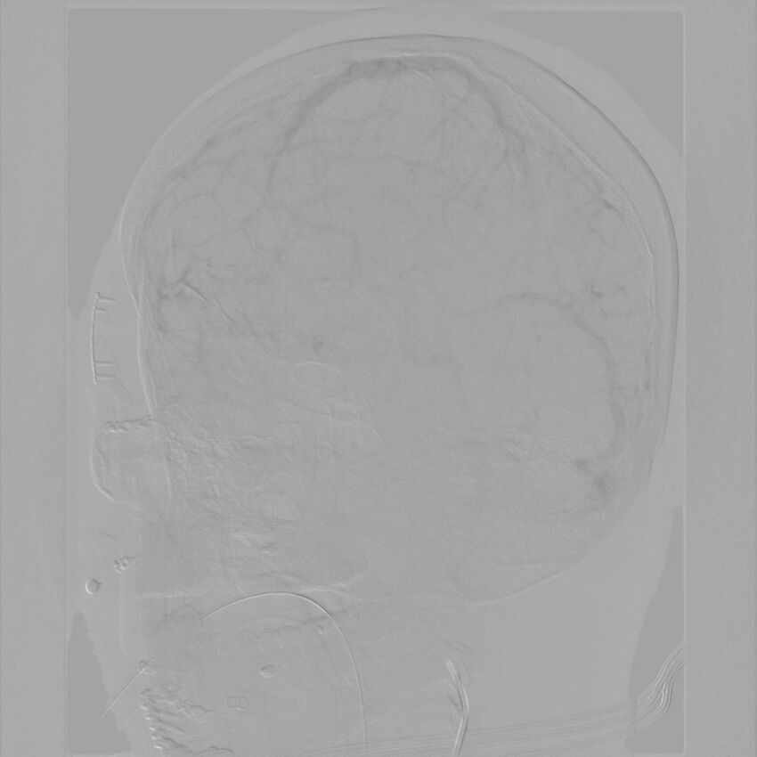 Caroticocavernous fistula - direct (Radiopaedia 61660-69666 Oblique Left ICA 55).jpg