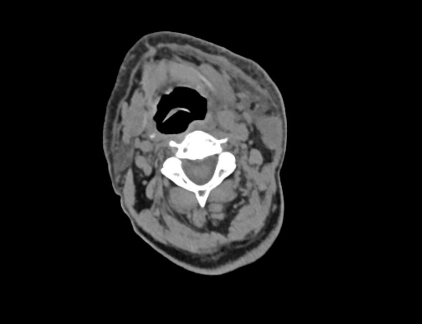 Carotid artery pseudoaneurysm (Radiopaedia 84030-99259 Axial non-contrast 15).jpg