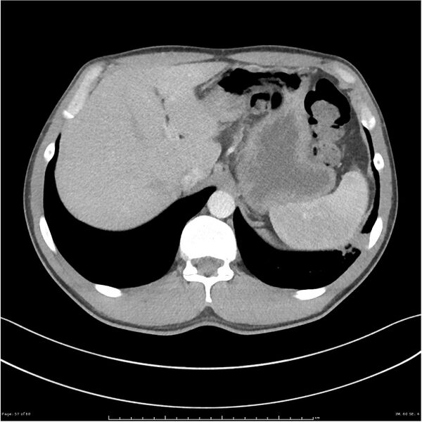File:Cavitating lung cancer (Radiopaedia 25796-25945 C+ arterial phase 57).jpg