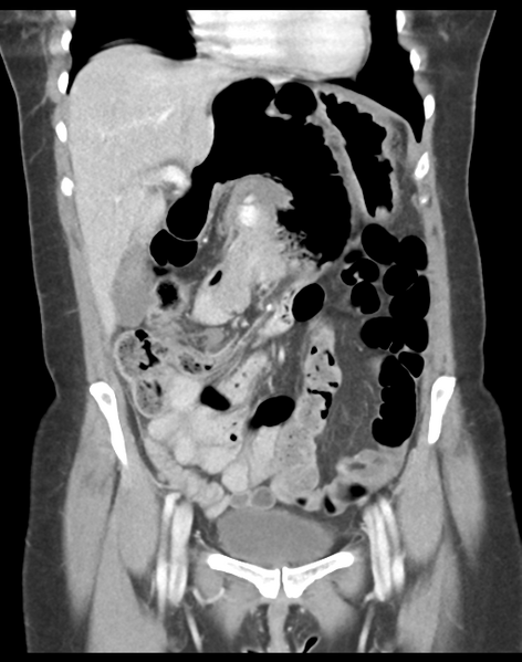 File:Cecum hernia through the foramen of Winslow (Radiopaedia 46634-51112 B 18).png