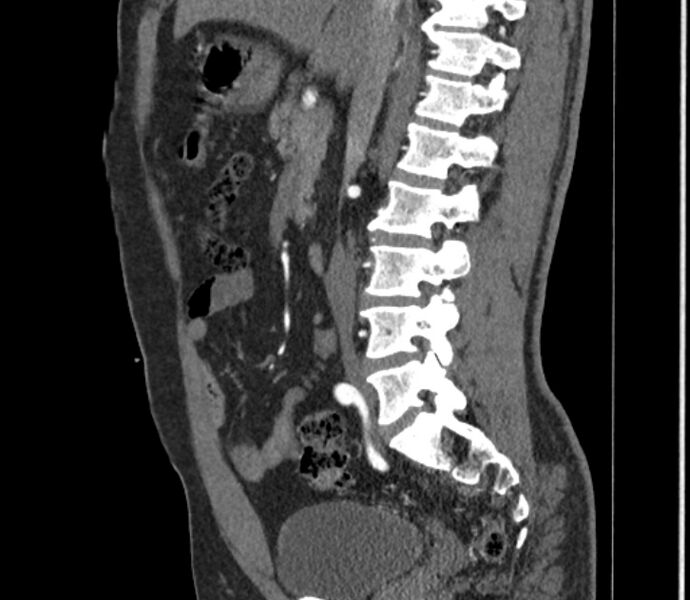 File:Celiac artery dissection (Radiopaedia 52194-58080 B 31).jpg