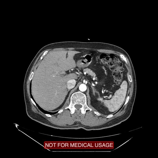 File:Celiac trunk variant anatomy - gastrohepatic trunk and splenic artery (Radiopaedia 38815-40995 A 15).jpg