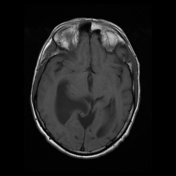 File:Central neurocytoma (Radiopaedia 67618-77021 Axial T1 11).jpg