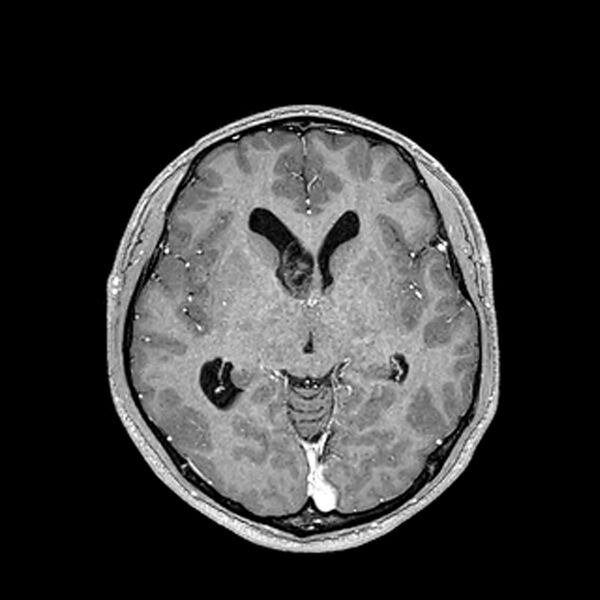 File:Central neurocytoma (Radiopaedia 79320-92380 Axial T1 C+ 118).jpg