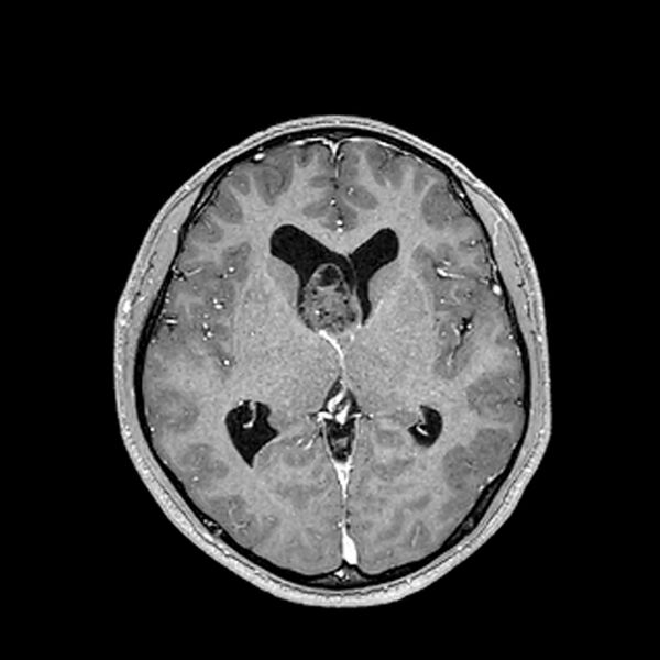 File:Central neurocytoma (Radiopaedia 79320-92380 Axial T1 C+ 126).jpg