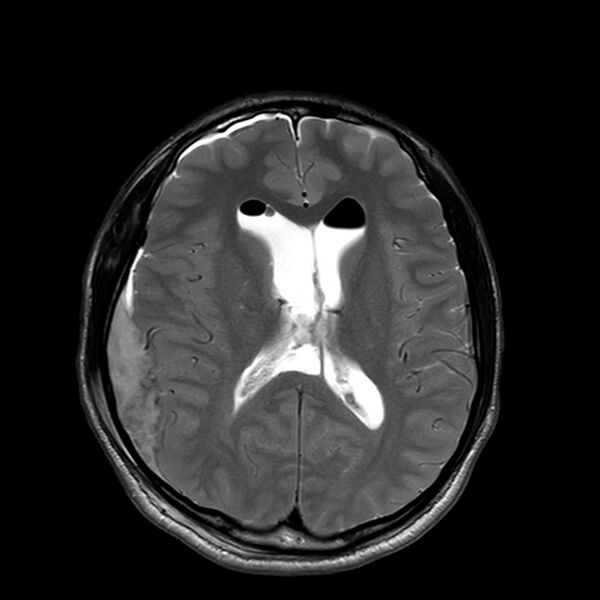 File:Central neurocytoma (Radiopaedia 79320-92381 Axial T2 15).jpg