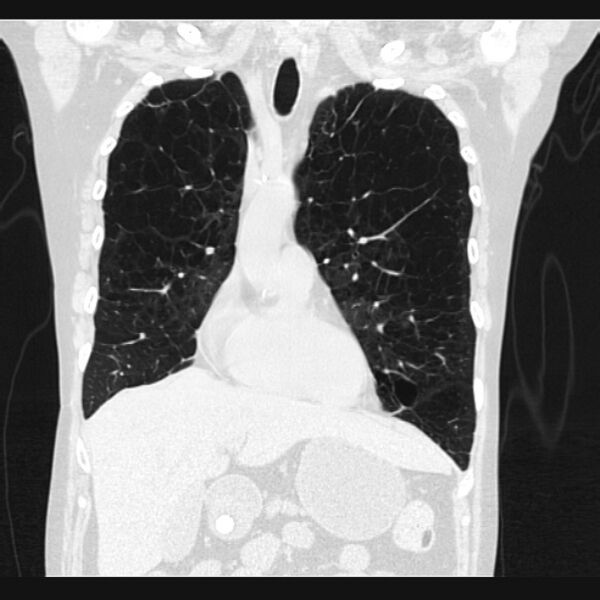 File:Centrilobular pulmonary emphysema (Radiopaedia 24495-24789 Coronal lung window 24).jpg