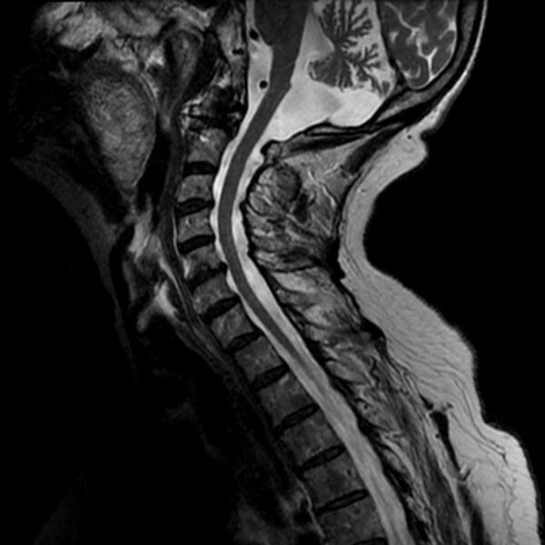File:Cerebellar ataxia with neuropathy and vestibular areflexia syndrome (CANVAS) (Radiopaedia 74283-85159 Sagittal T2 5).jpg