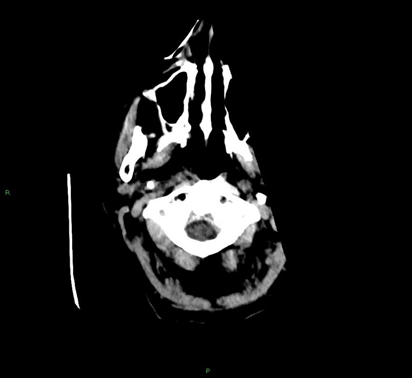 Cerebellar hemorrhage (Radiopaedia 58792-66026 Axial non-contrast 51).jpg