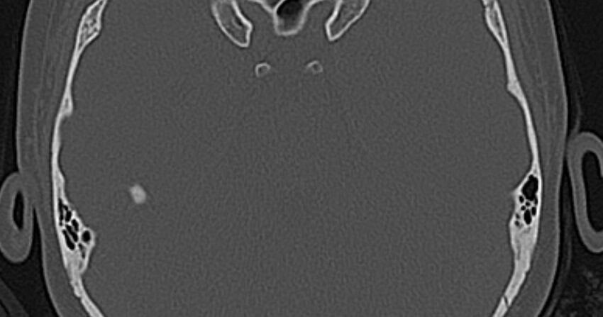 Cerebellopontine angle lipoma (Radiopaedia 57303-64242 Axial bone window 54).jpg