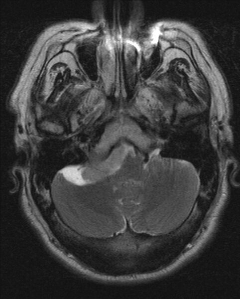 File:Cerebellopontine angle meningioma (Radiopaedia 24459-24764 Axial T2 4).jpg