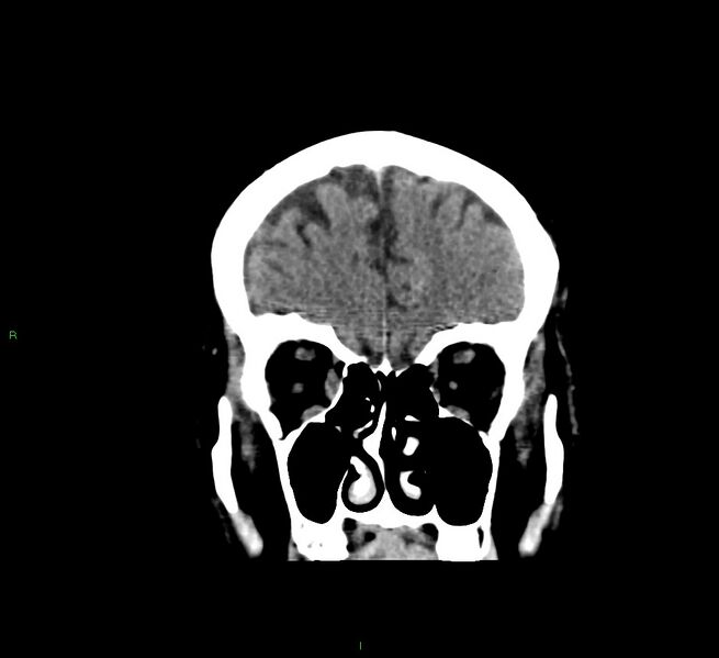 File:Cerebral amyloid angiopathy-associated lobar intracerebral hemorrhage (Radiopaedia 58376-65511 Coronal non-contrast 52).jpg