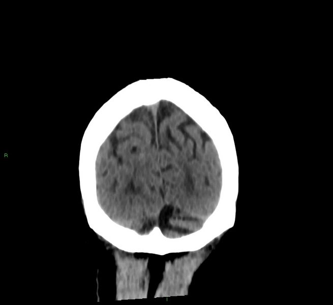 File:Cerebral amyloid angiopathy-associated lobar intracerebral hemorrhage (Radiopaedia 58376-65513 Coronal non-contrast 21).jpg