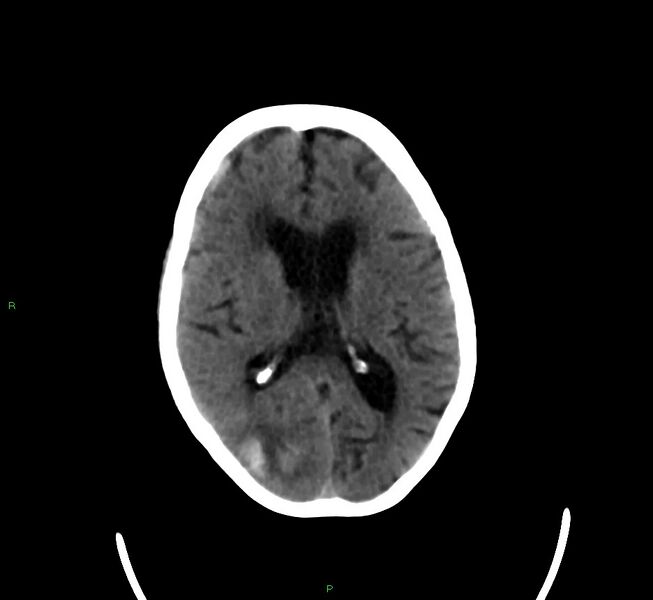 File:Cerebral amyloid angiopathy-associated lobar intracerebral hemorrhage (Radiopaedia 58377-65514 Axial non-contrast 23).jpg