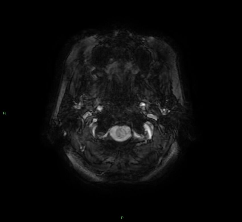 Cerebral amyloid angiopathy-associated lobar intracerebral hemorrhage (Radiopaedia 58378-65517 Axial SWI 2).jpg