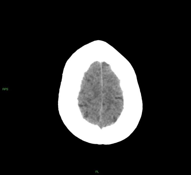 File:Cerebral amyloid angiopathy-associated lobar intracerebral hemorrhage (Radiopaedia 58569-65734 Axial non-contrast 14).jpg