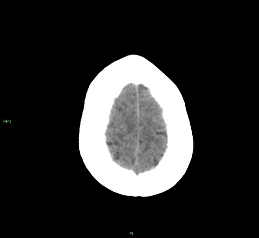 Cerebral amyloid angiopathy-associated lobar intracerebral hemorrhage (Radiopaedia 58569-65734 Axial non-contrast 14).jpg