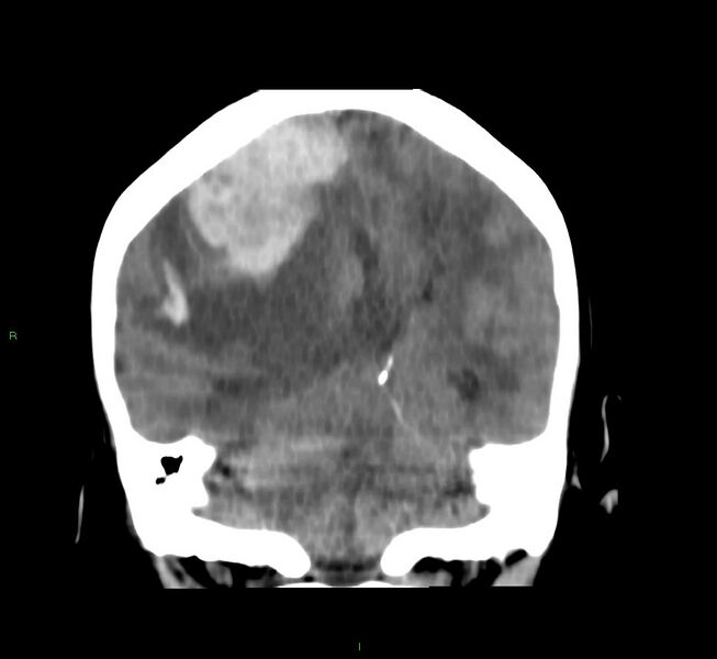 File:Cerebral amyloid angiopathy-associated lobar intracerebral hemorrhage (Radiopaedia 58751-65972 Coronal non-contrast 26).jpg