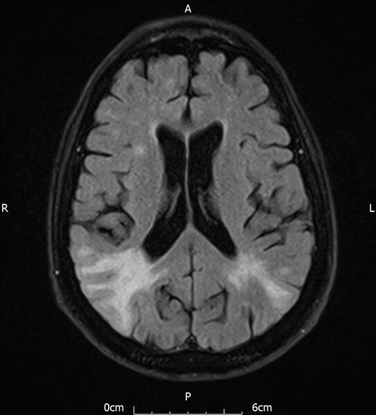 File:Cerebral amyloid angiopathy related inflammation (Radiopaedia 72772-83415 Axial FLAIR 14).jpg