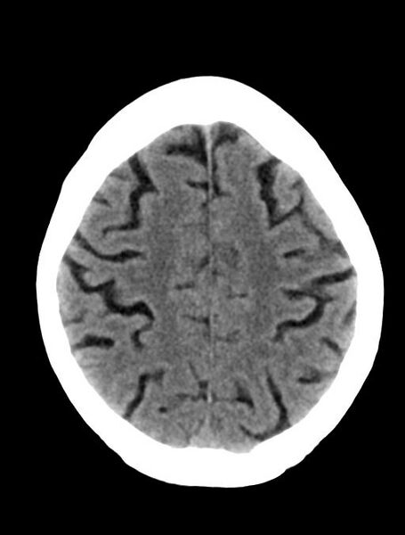 File:Cerebral aneurysm with rupture (Radiopaedia 29933-30457 Axial non-contrast 20).jpg
