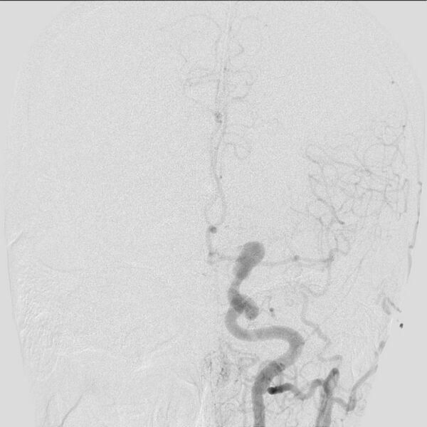 File:Cerebral aneurysm with rupture (Radiopaedia 29933-30458 LT ICA IC 14).jpg