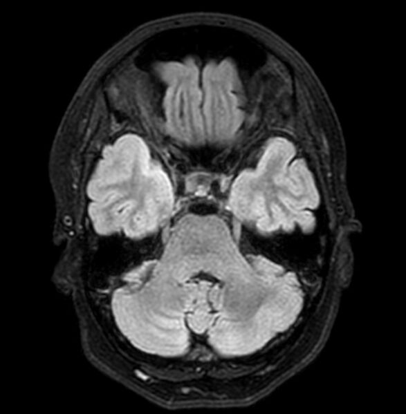File:Cerebral arteriovenous malformation (Radiopaedia 74411-90758 Axial FLAIR 9).jpg