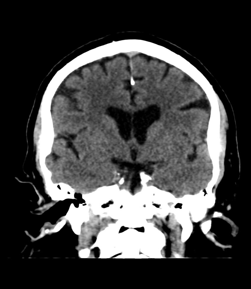 Cerebral dural venous sinus thrombosis (Radiopaedia 86514-102575 Coronal non-contrast 21).jpg