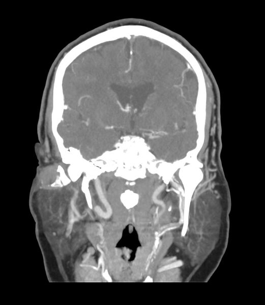File:Cerebral dural venous sinus thrombosis (Radiopaedia 86514-102576 B 30).jpg