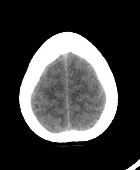 File:Cerebral edema due to severe hyponatremia (Radiopaedia 89826-106937 Axial non-contrast 81).jpg