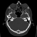 Cerebral hemorrhagic contusions (Radiopaedia 23145-23188 Axial bone window 13).jpg