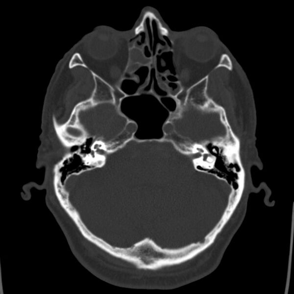 File:Cerebral hemorrhagic contusions (Radiopaedia 23145-23188 Axial bone window 13).jpg