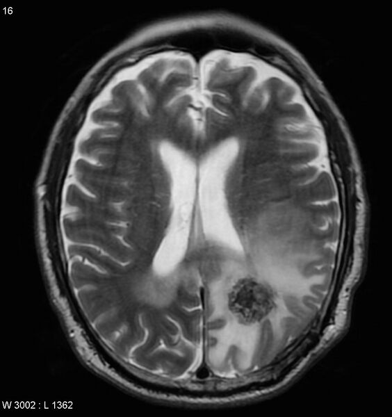 File:Cerebral radiation necrosis (Radiopaedia 5665-7376 Axial T2 1).jpg