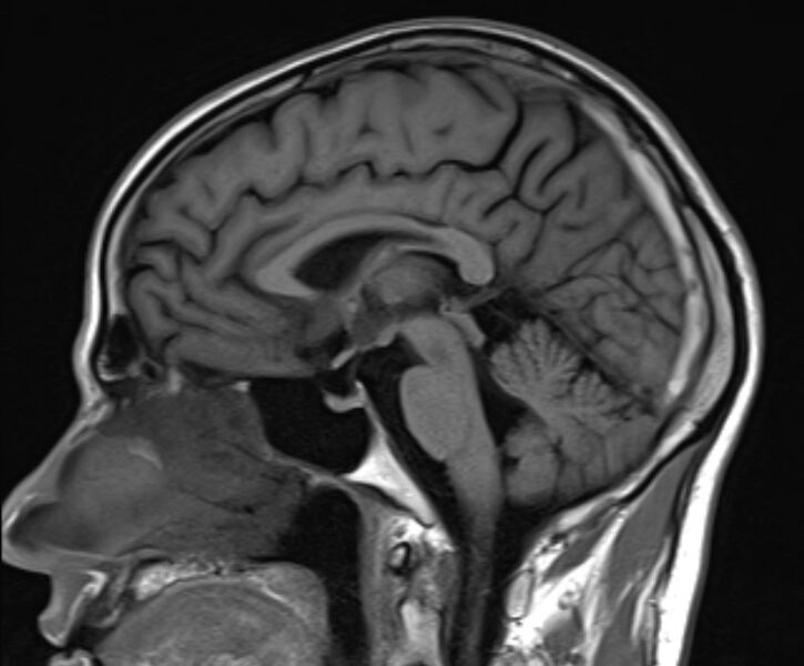File:Cerebral venous thrombosis (Radiopaedia 71207-81504 Sagittal T1 13).jpg