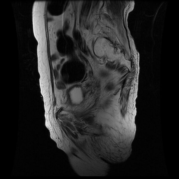 File:Cervical carcinoma (Radiopaedia 78847-91705 Sagittal T2 12).jpg