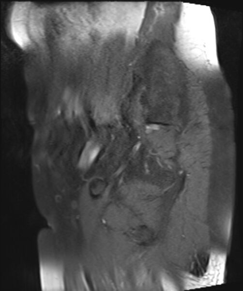 File:Cervical carcinoma (Radiopaedia 88312-104943 Sagittal T1 fat sat 24).jpg