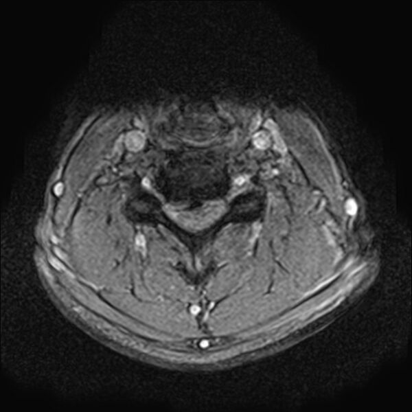 File:Cervical compressive myelopathy (Radiopaedia 71956-82411 Axial 3D-T2* 13).jpg