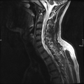 Cervical dural CSF leak on MRI and CT treated by blood patch (Radiopaedia 49748-54995 Sagittal T2 4).png