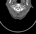 Cervical dural CSF leak on MRI and CT treated by blood patch (Radiopaedia 49748-54996 B 12).png