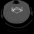 Cervical flexion teardrop fracture with cord hemorrhage (Radiopaedia 32497-33454 Axial bone window 43).jpg