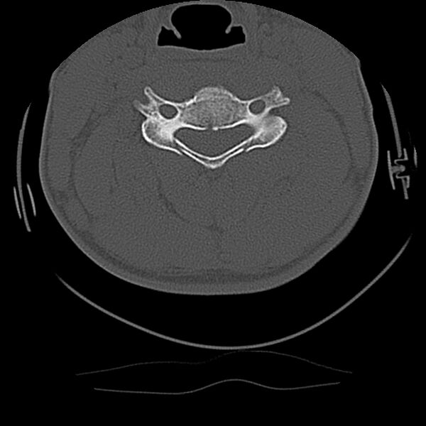File:Cervical flexion teardrop fracture with cord hemorrhage (Radiopaedia 32497-33454 Axial bone window 43).jpg