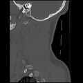 Cervical flexion teardrop fracture with cord hemorrhage (Radiopaedia 32497-33454 Sagittal bone window 40).jpg