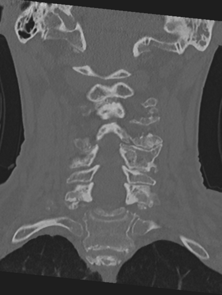 File:Cervical spondylolysis (Radiopaedia 49616-54811 Coronal bone window 28).png