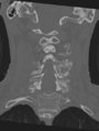 Cervical spondylolysis (Radiopaedia 49616-54811 Coronal bone window 28).png