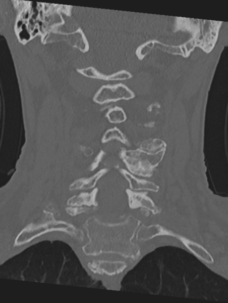 File:Cervical spondylolysis (Radiopaedia 49616-54811 Coronal bone window 29).png