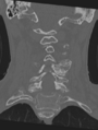 Cervical spondylolysis (Radiopaedia 49616-54811 Coronal bone window 29).png